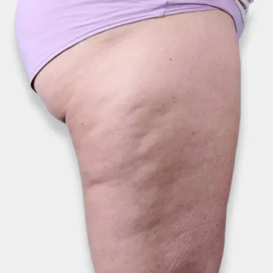 Wie kann man Cellulite wirksam bekämpfen?