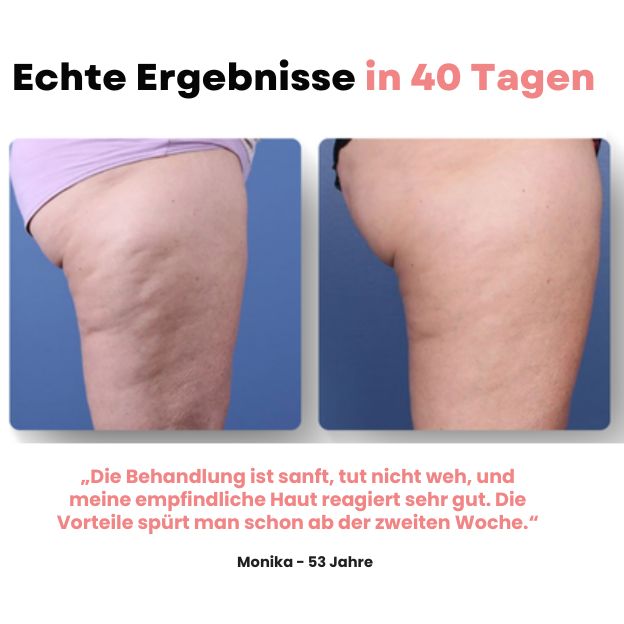 Skinora™ - Anti-Cellulite-Massagegerät