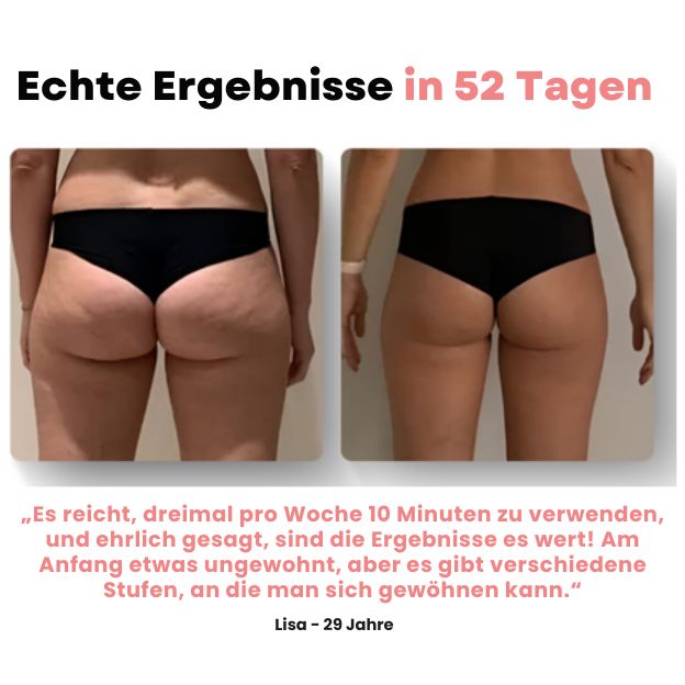 Skinora™ - Anti-Cellulite-Massagegerät